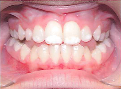 Tooth ‘disfigurement’ law suit without merit: Nestlé Waters